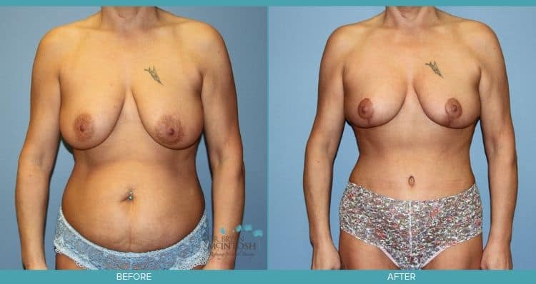 Breast Reduction, Liposuction, Abdominoplasty