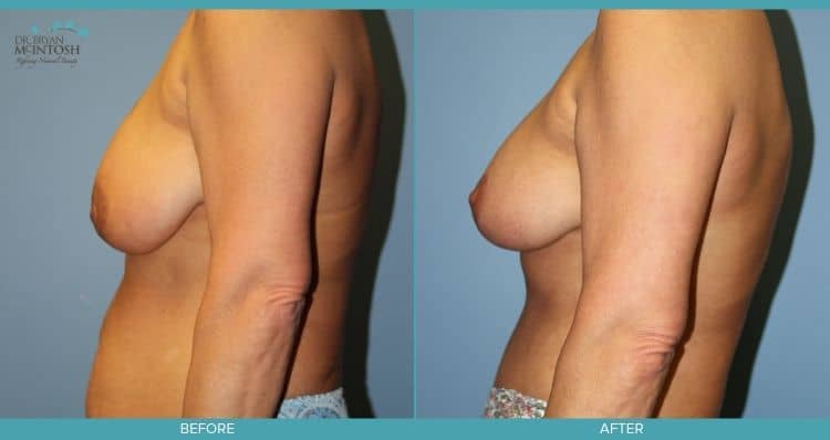 Breast Reduction, Liposuction, Abdominoplasty