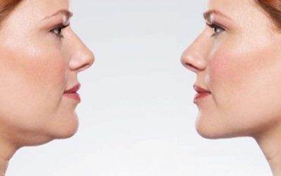 Kybella: Get Rid Of Your Double Chin, Easily And Effortlessly With An Injectable Treatment!