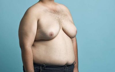 Gynecomastia: 10 Common Questions Men Ask About Male Breast Reduction Surgery