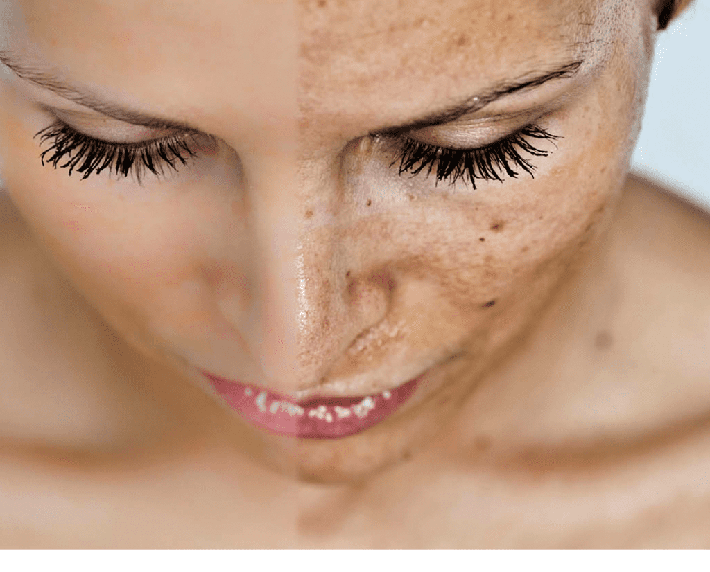 Photorejuvenation-IPL-Treatment-for-visible-sun-damaged-skin