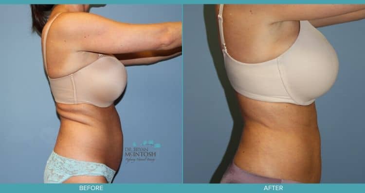 liposuction to the abdomen and waist and a back lift3