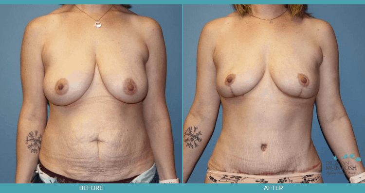 Breast Reduction & Tuck