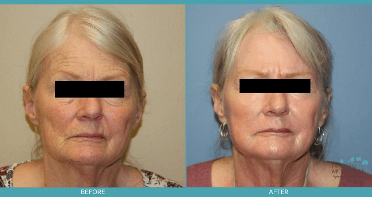 Fractional C02 Laser and Botox