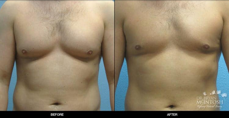 Male Breast Reduction in Seattle