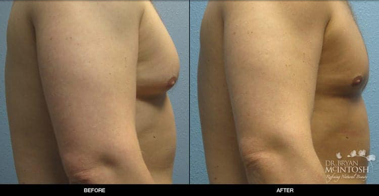 Male Breast Reduction in Seattle