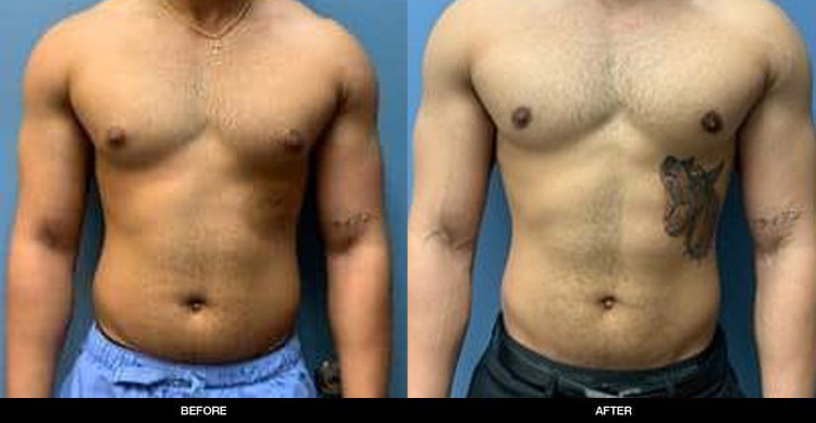 Gynecomastia Surgery – Male Breast Reduction - Bellevue & Kirkland