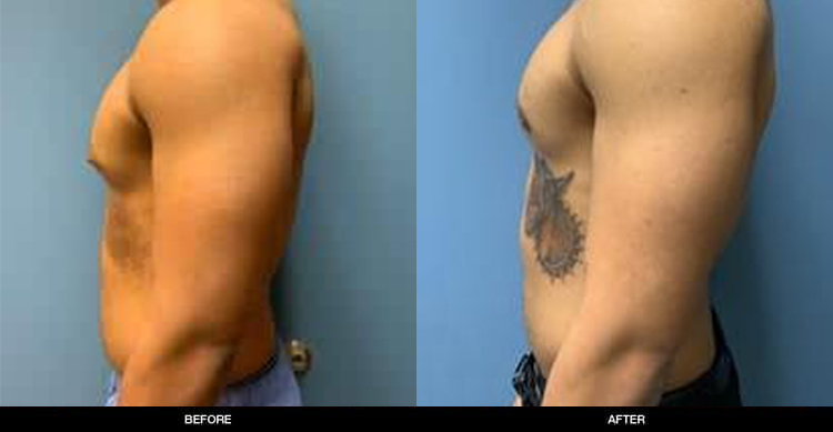 Male Breast Reduction in Seattle