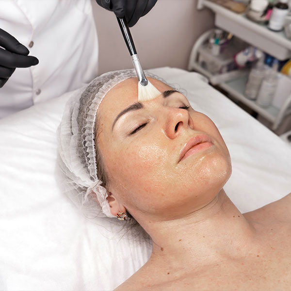 chemical-peel-expect